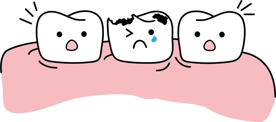 Grafik von drei Zähnen. Der Zahn in der Mitte weint. Er hat Karies und Schmerzen. Die beiden Zähne neben ihm gucken erschrocken.